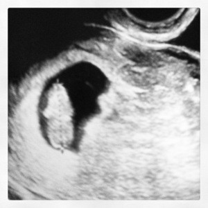 Baby K's 1st Ultrasound